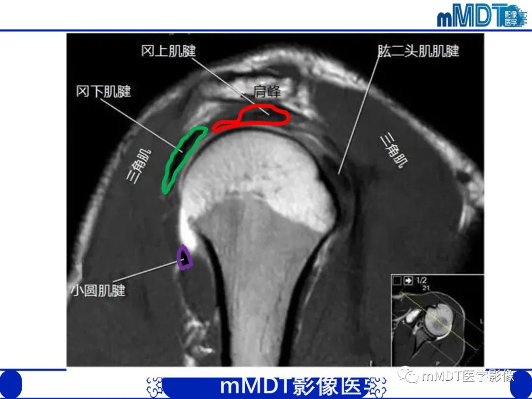 【PPT】肩关节撞击综合征-35