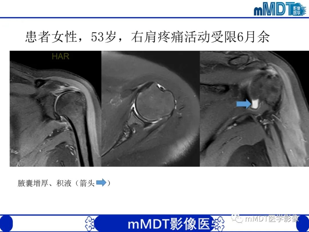 【PPT】肩关节撞击综合征-73