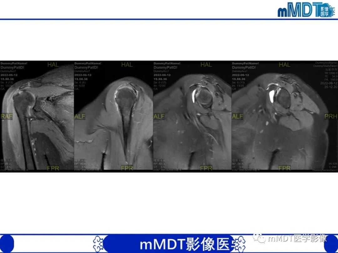 【PPT】肩关节撞击综合征-95