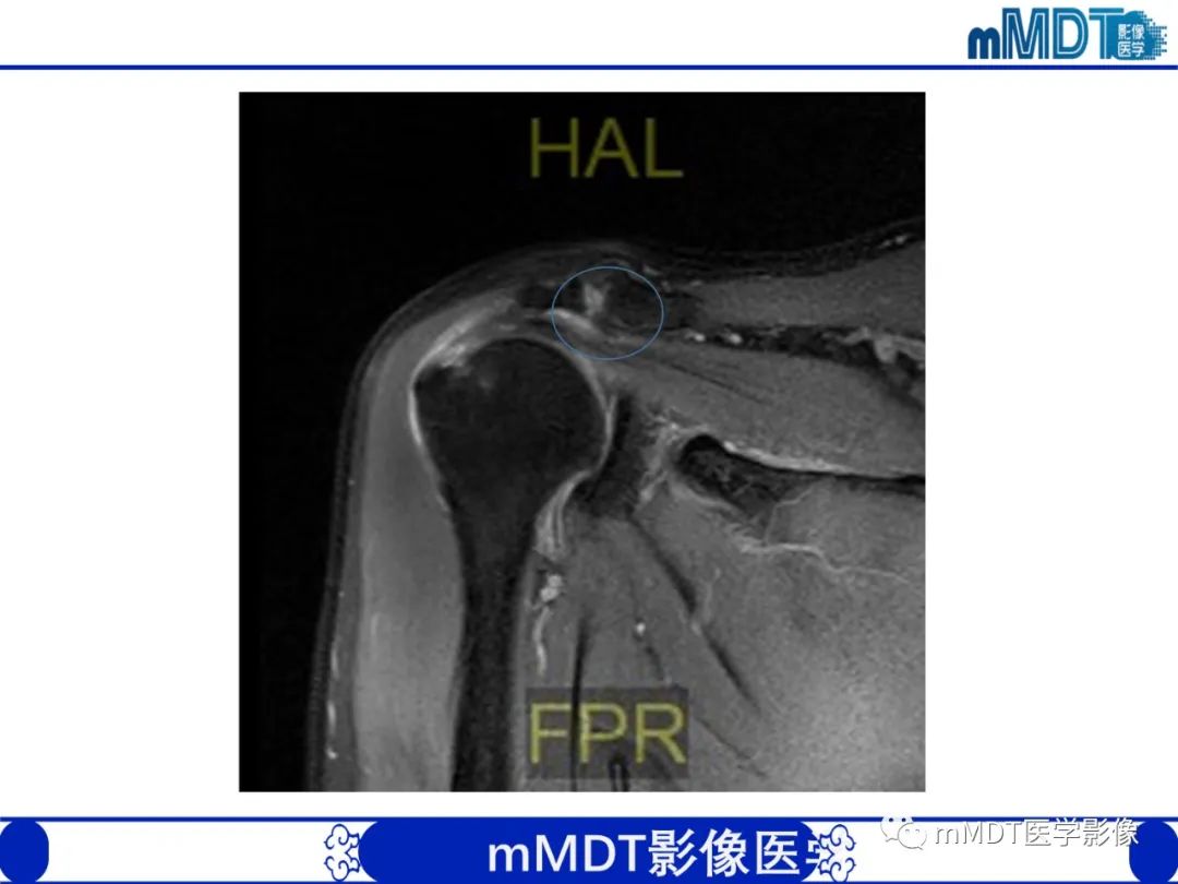【PPT】肩关节撞击综合征-55