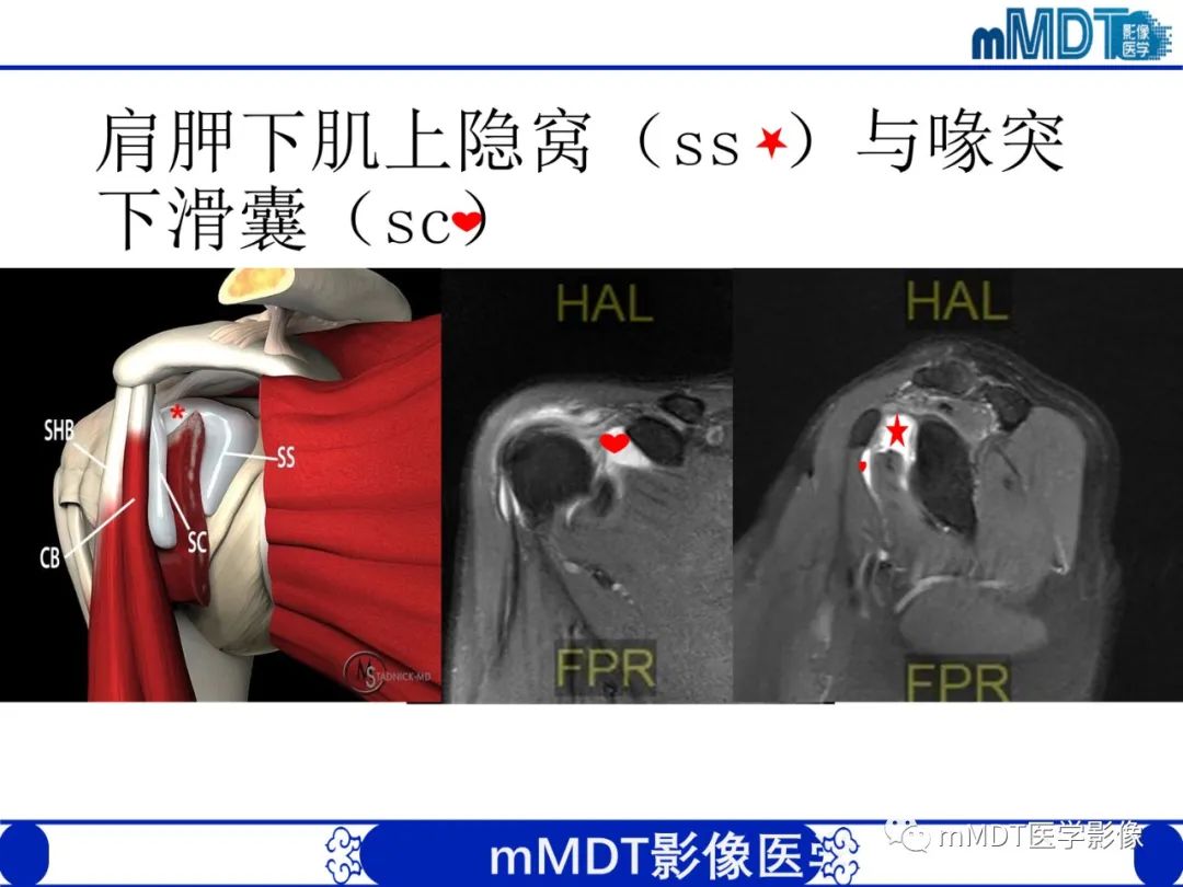 【PPT】肩关节撞击综合征-38