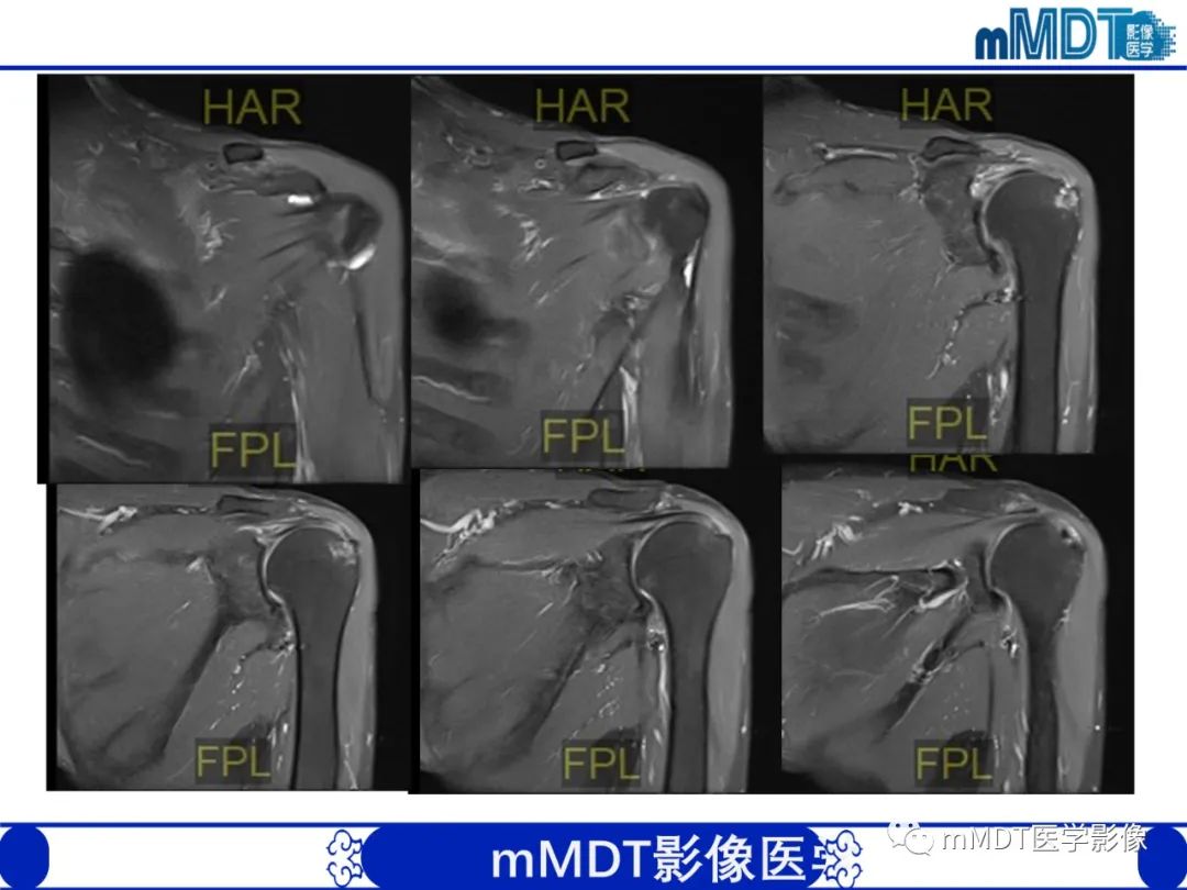 【PPT】肩关节撞击综合征-1