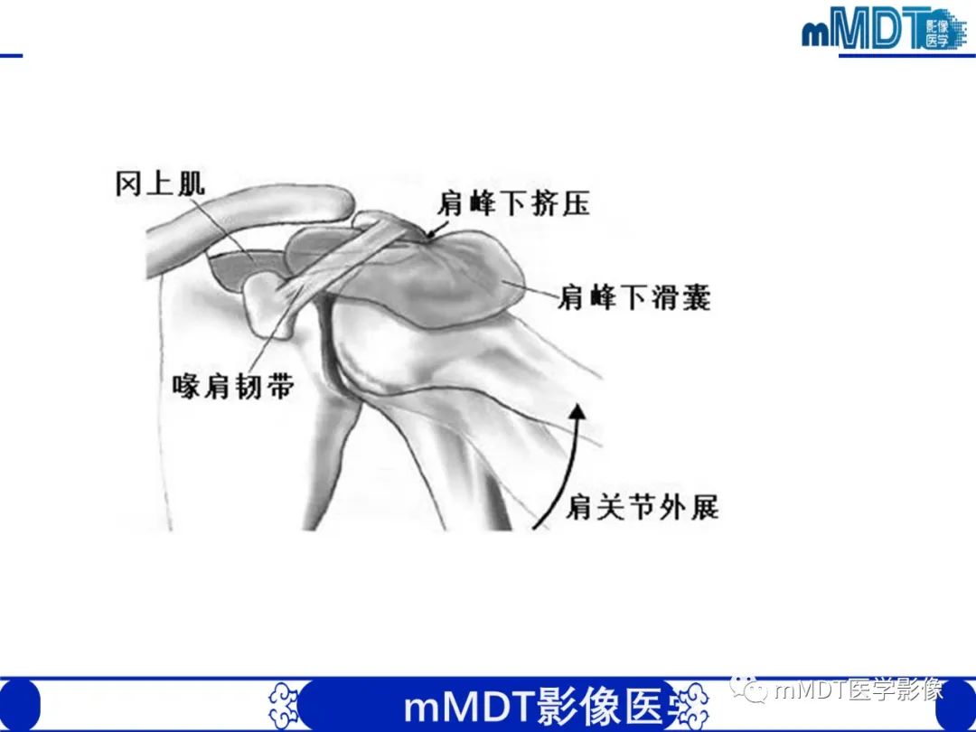 【PPT】肩关节撞击综合征-42