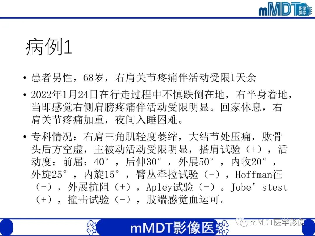 肩关节撞击综合征