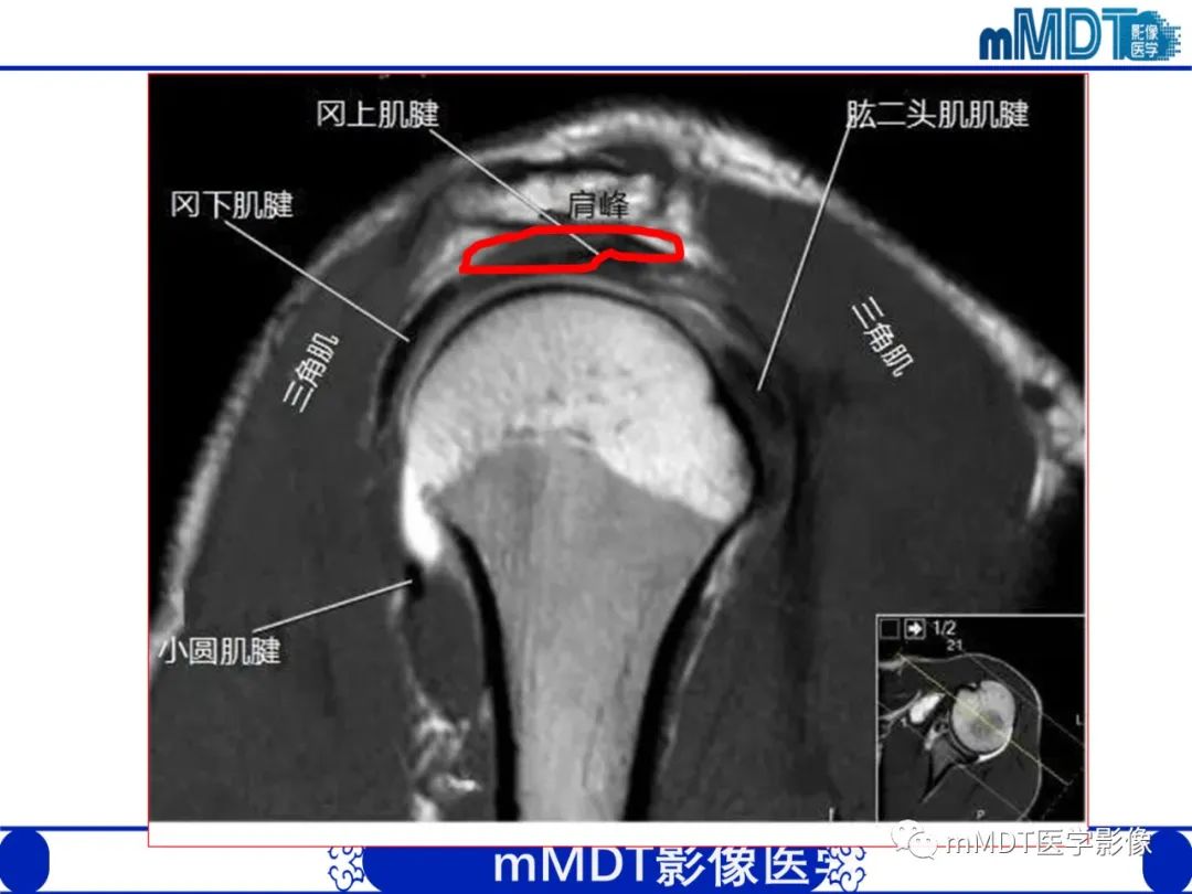 【PPT】肩关节撞击综合征-23