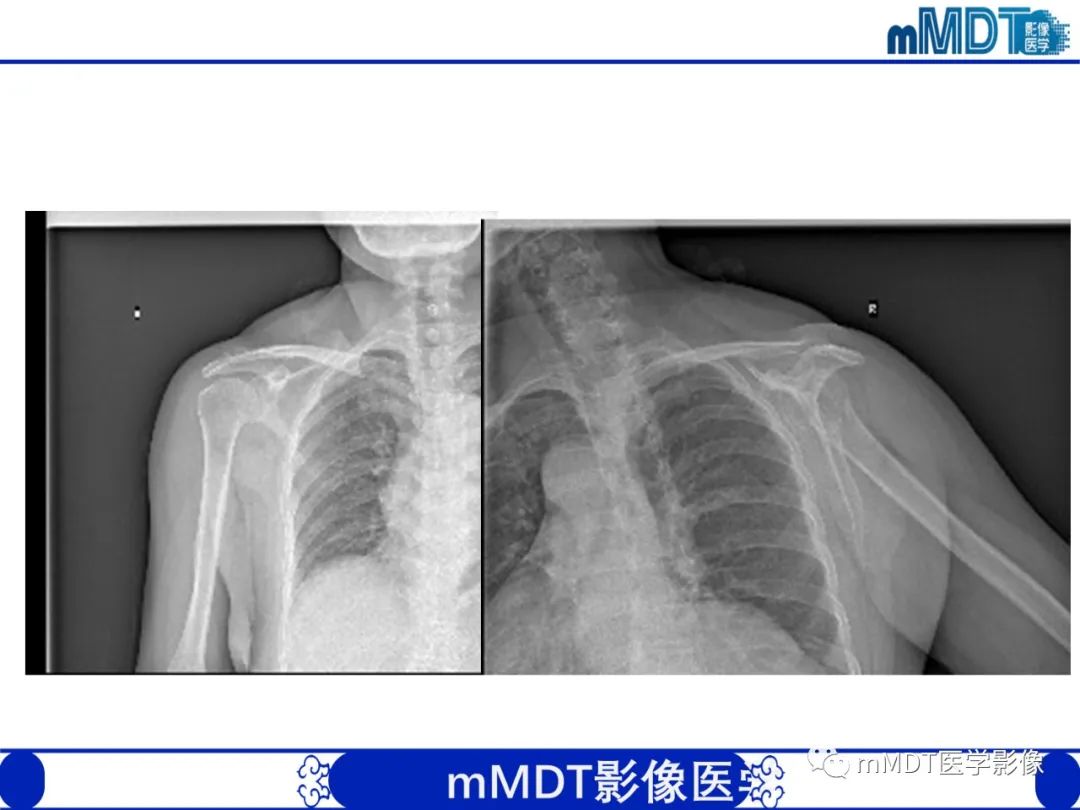 【PPT】肩关节撞击综合征-93