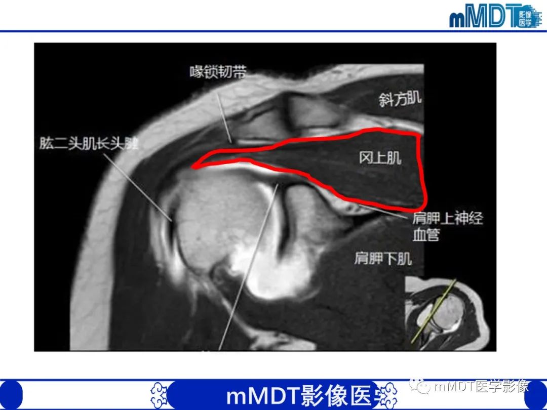 【PPT】肩关节撞击综合征-22