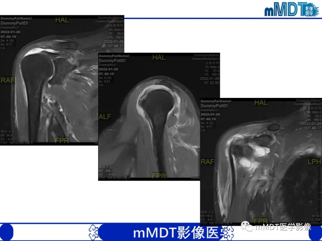 【PPT】肩关节撞击综合征-2