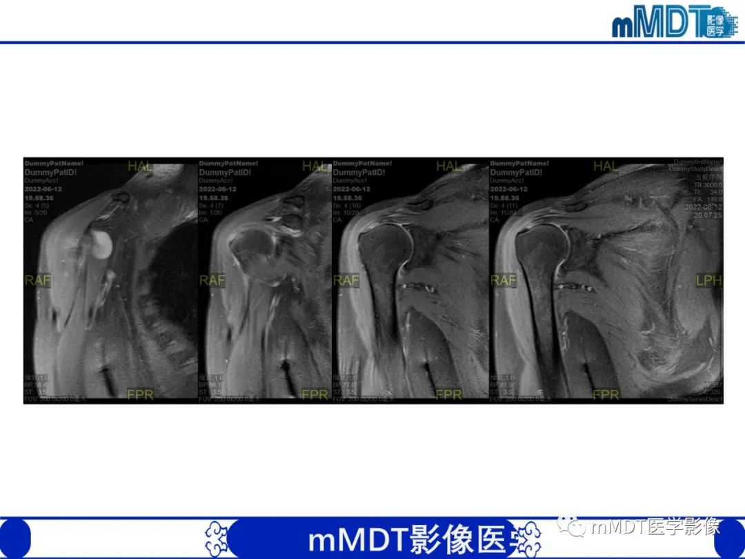 【PPT】肩关节撞击综合征-94