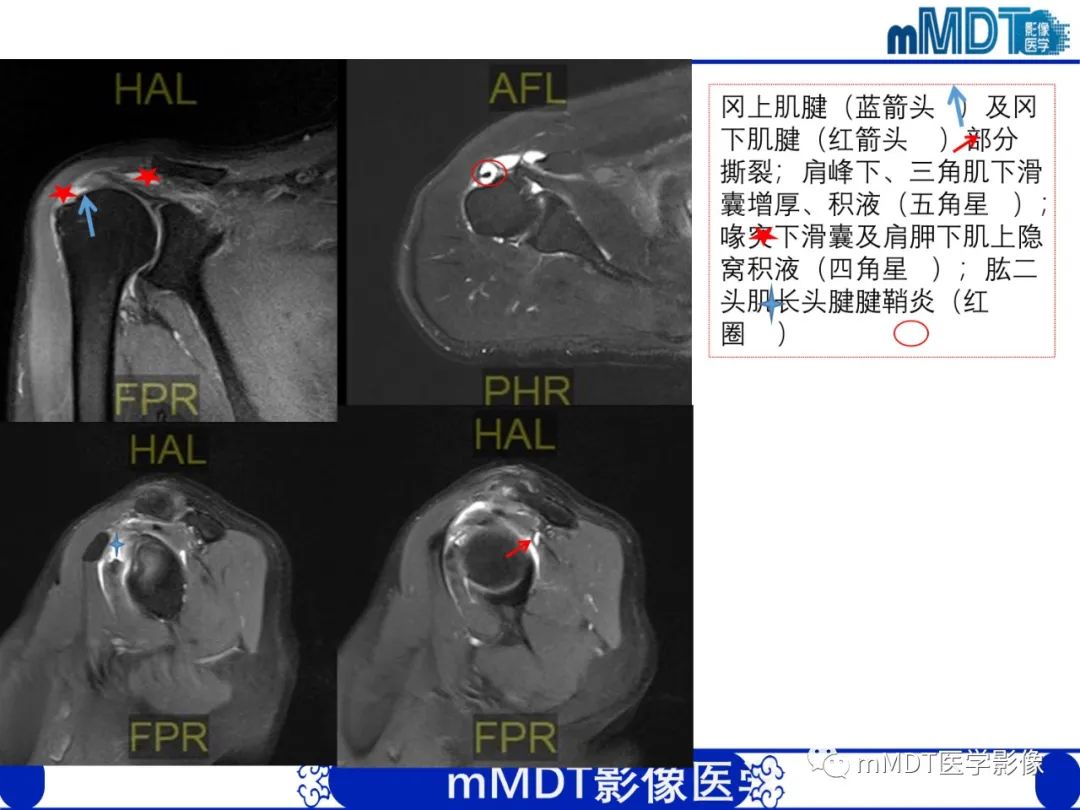 【PPT】肩关节撞击综合征-81