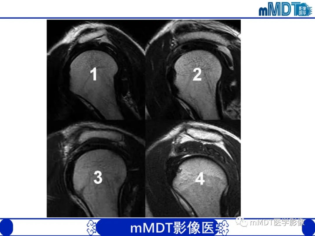 【PPT】肩关节撞击综合征-50