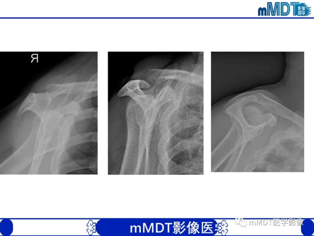 【PPT】肩关节撞击综合征-51