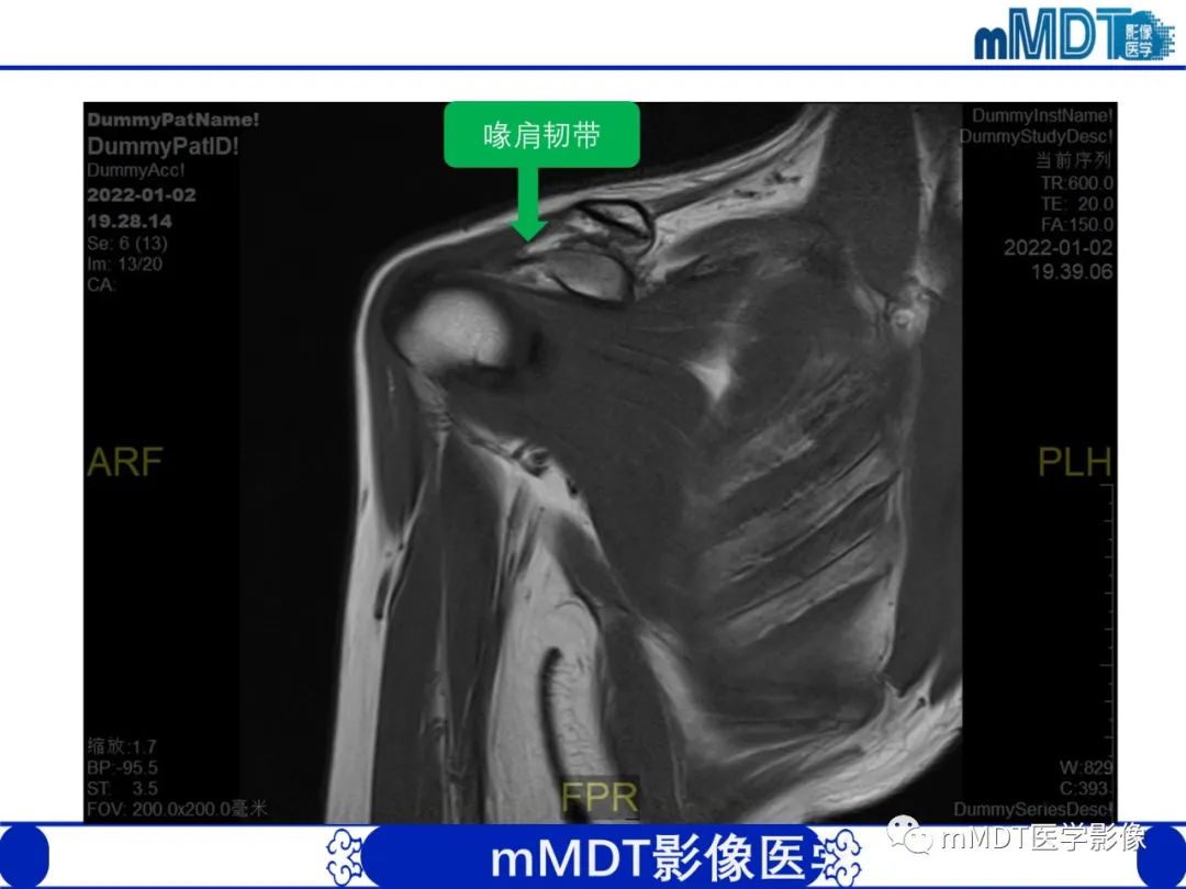 【PPT】肩关节撞击综合征-14