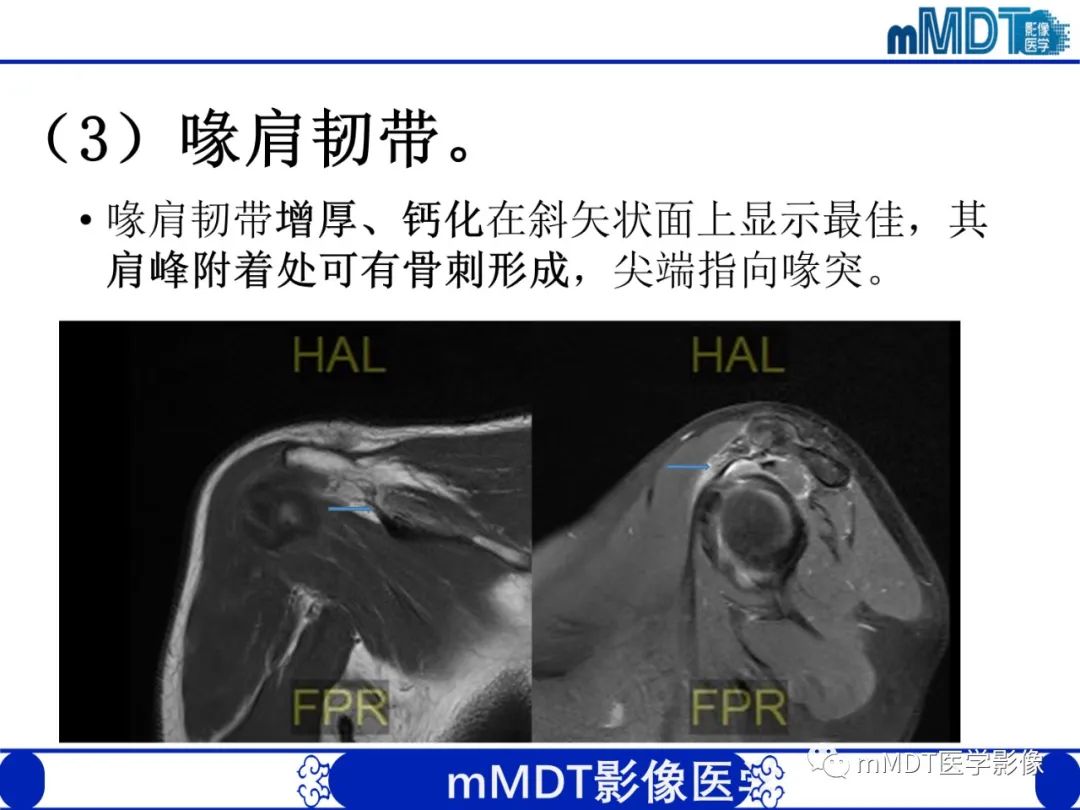 【PPT】肩关节撞击综合征-56