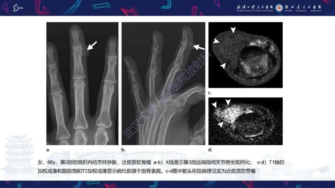 【PPT】指骨肿瘤影像诊断-21