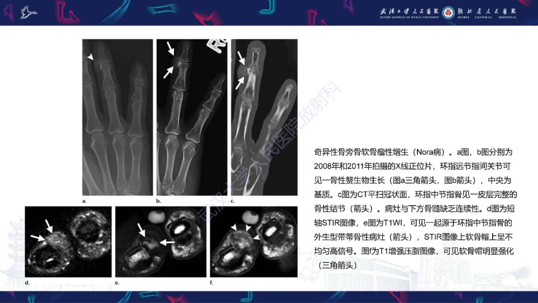 【PPT】指骨肿瘤影像诊断-34