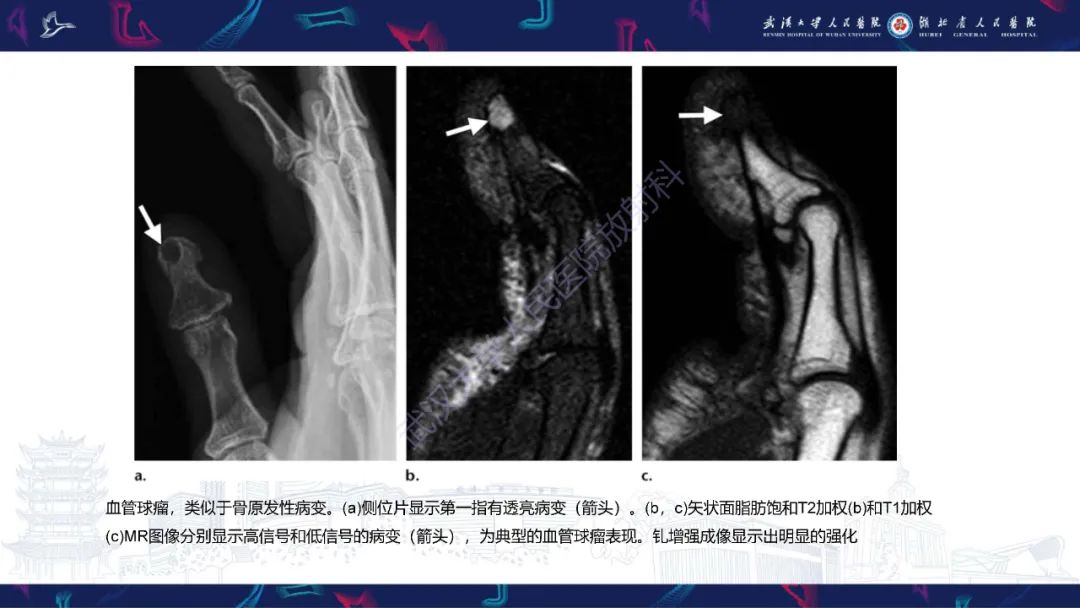 【PPT】指骨肿瘤影像诊断-42