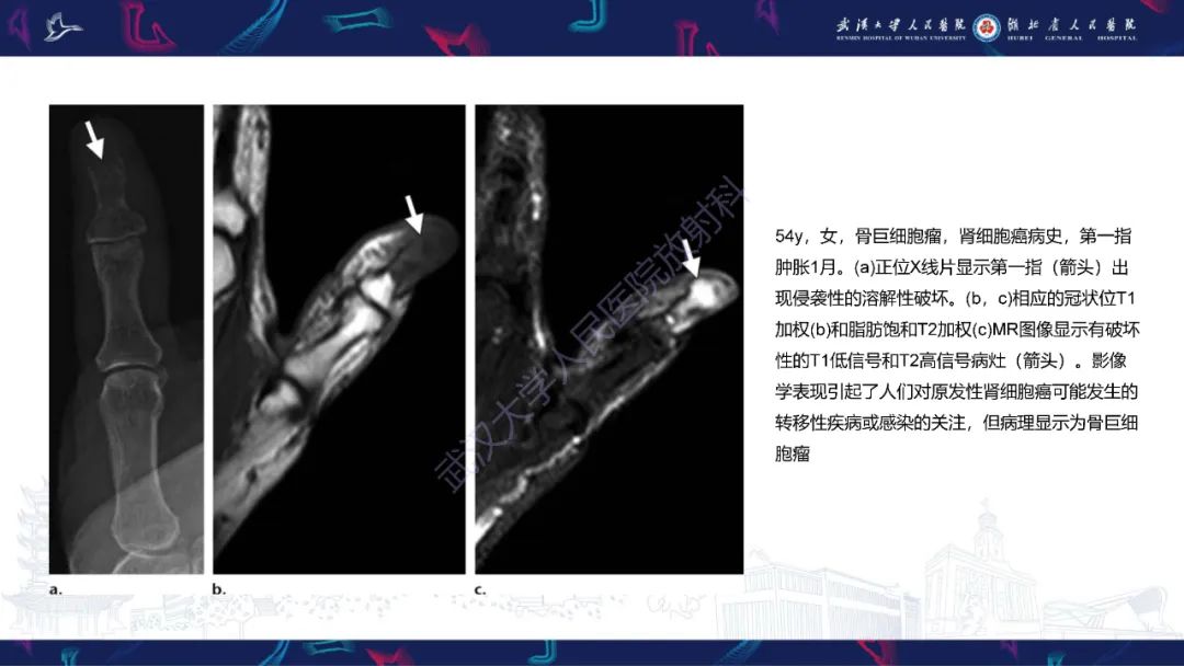 【PPT】指骨肿瘤影像诊断-40