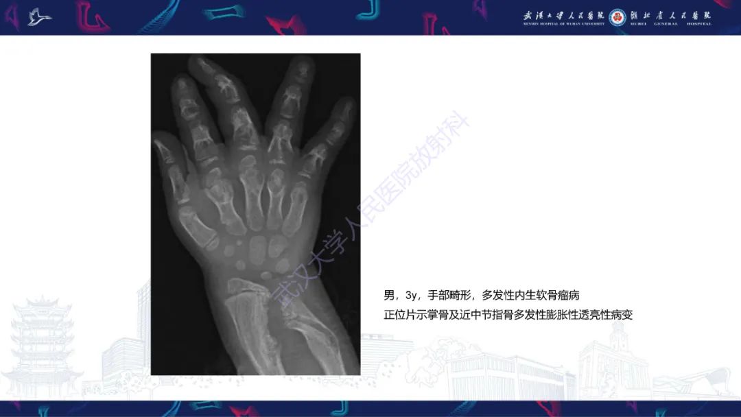 【PPT】指骨肿瘤影像诊断-19