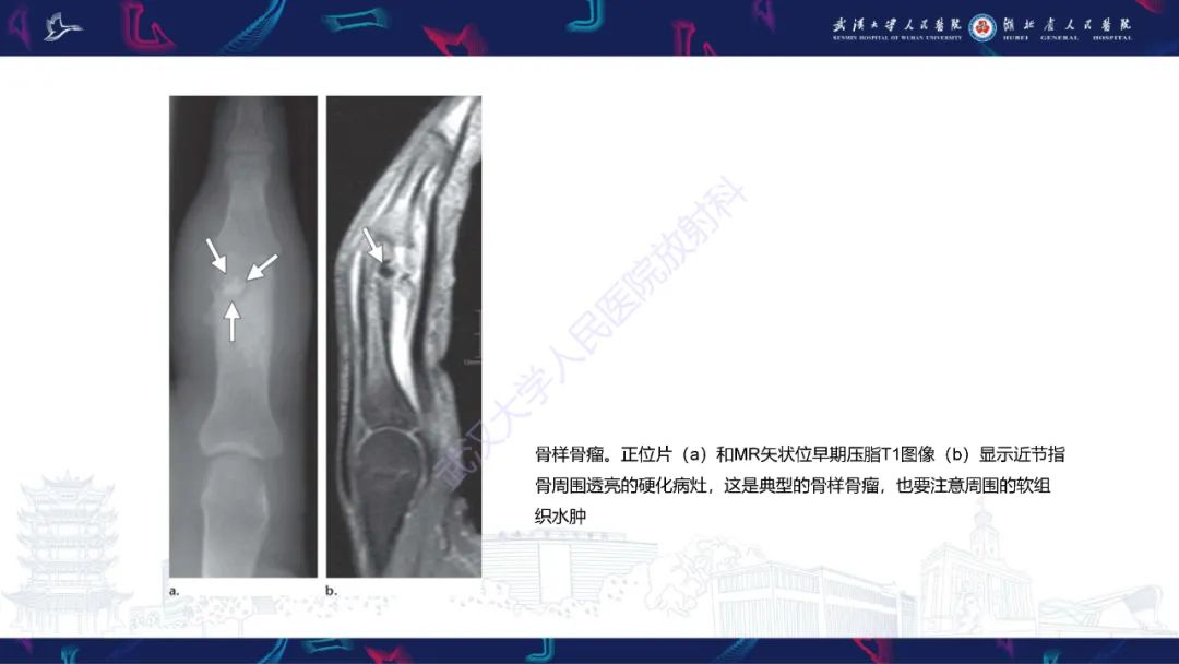 【PPT】指骨肿瘤影像诊断-37