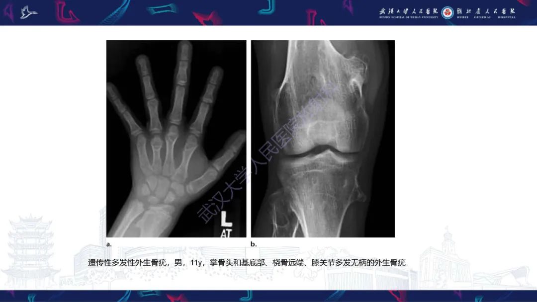 【PPT】指骨肿瘤影像诊断-26