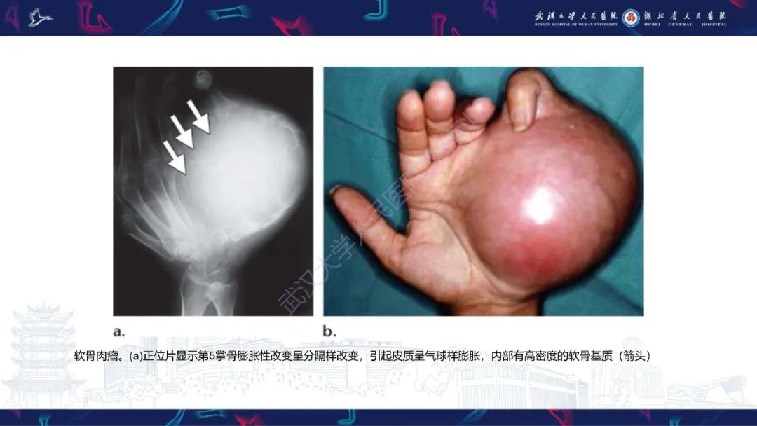 【PPT】指骨肿瘤影像诊断-49