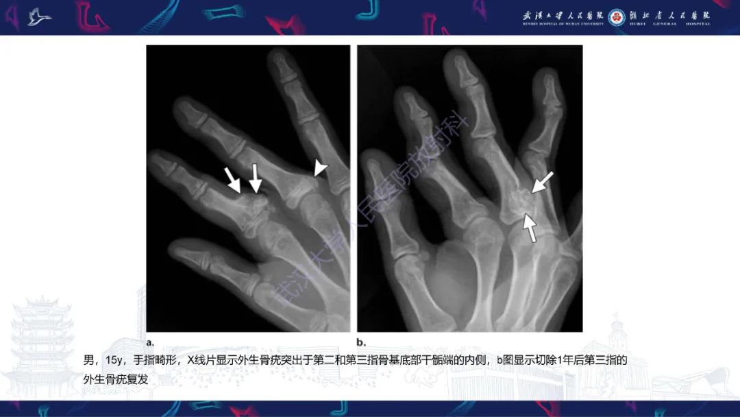【PPT】指骨肿瘤影像诊断-24