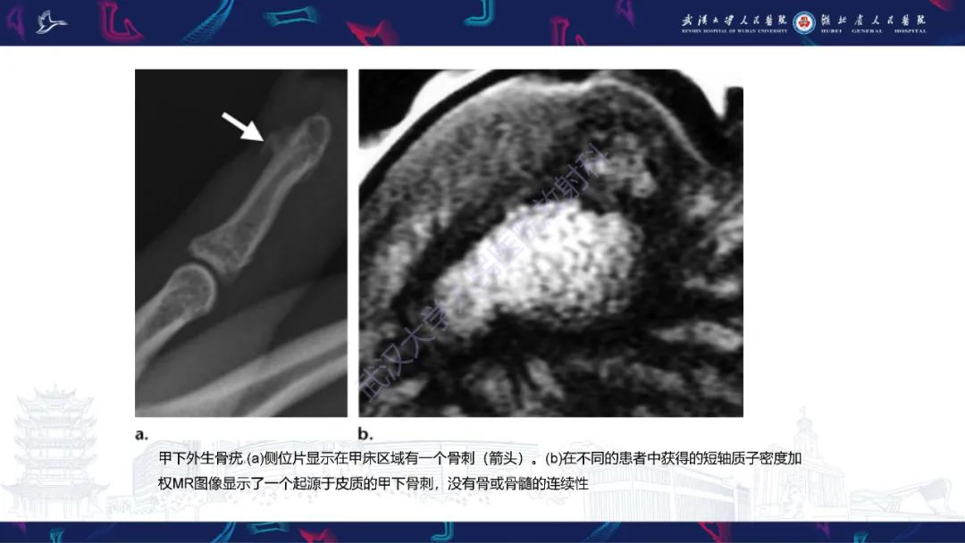 【PPT】指骨肿瘤影像诊断-29
