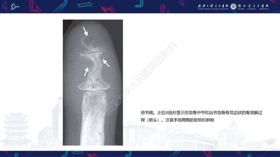 【PPT】指骨肿瘤影像诊断-46