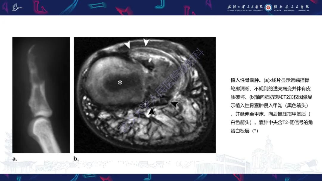 【PPT】指骨肿瘤影像诊断-44