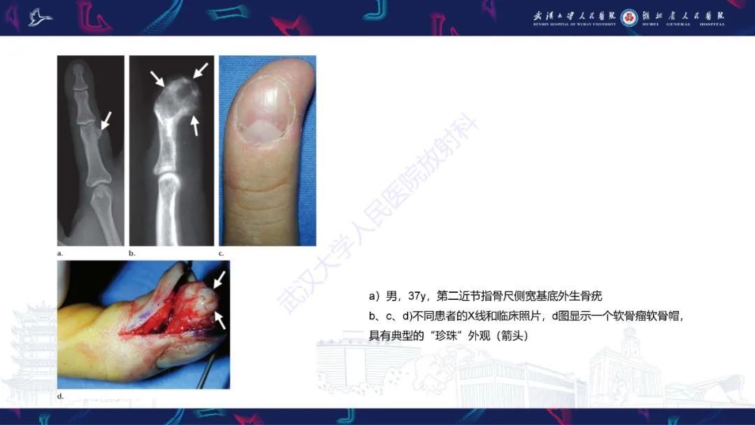 【PPT】指骨肿瘤影像诊断-23