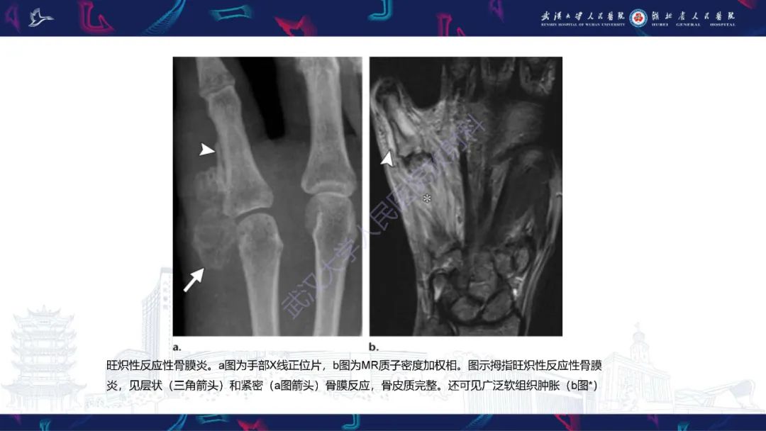【PPT】指骨肿瘤影像诊断-31