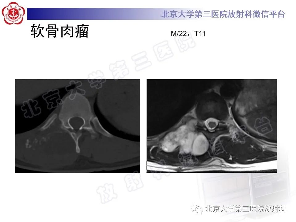 【PPT】脊柱软骨肉瘤-22