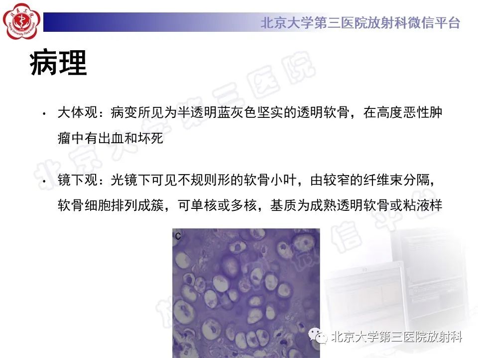 【PPT】脊柱软骨肉瘤-18