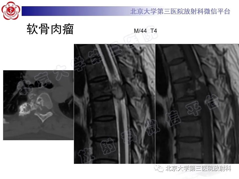 【PPT】脊柱软骨肉瘤-23