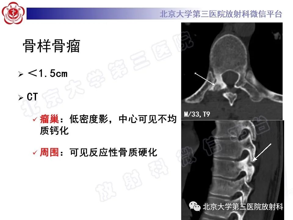 【PPT】脊柱软骨肉瘤-27