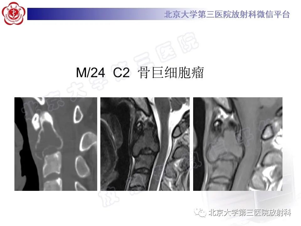 【PPT】脊柱软骨肉瘤-28