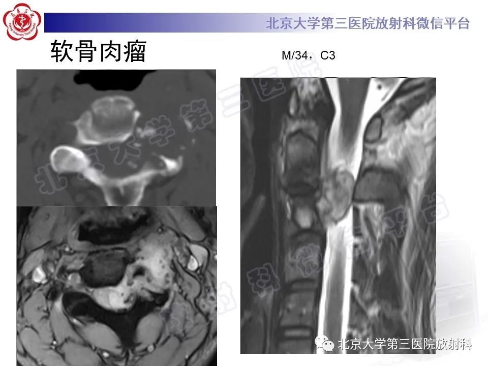 【PPT】脊柱软骨肉瘤-21