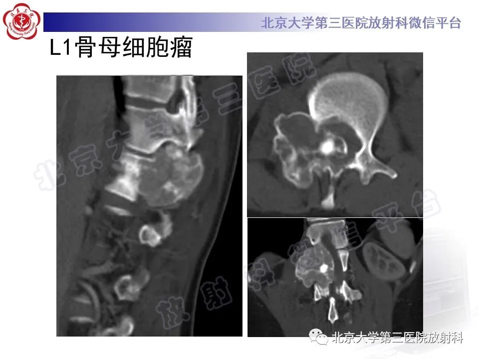 【PPT】脊柱软骨肉瘤-25