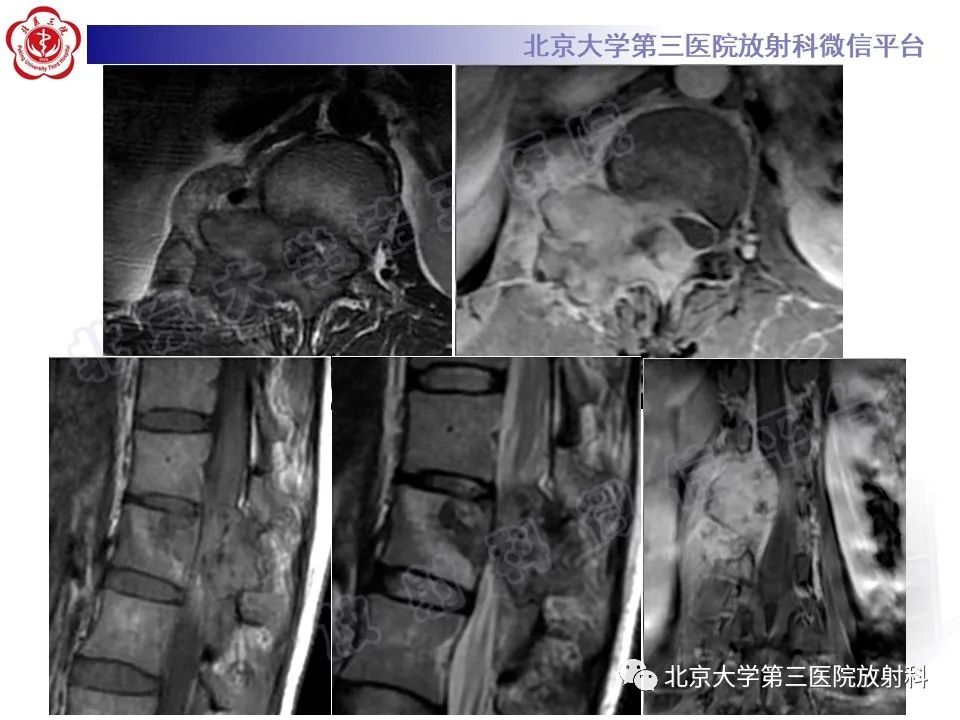 【PPT】脊柱软骨肉瘤-26