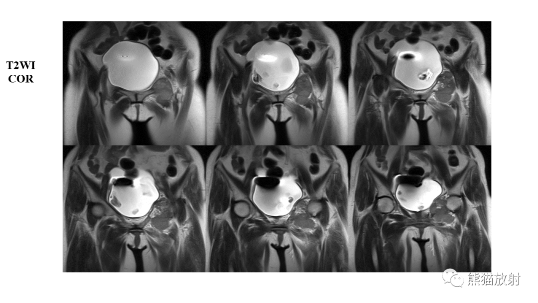 【病例】软骨肉瘤I级 VS 去分化软骨肉瘤-17