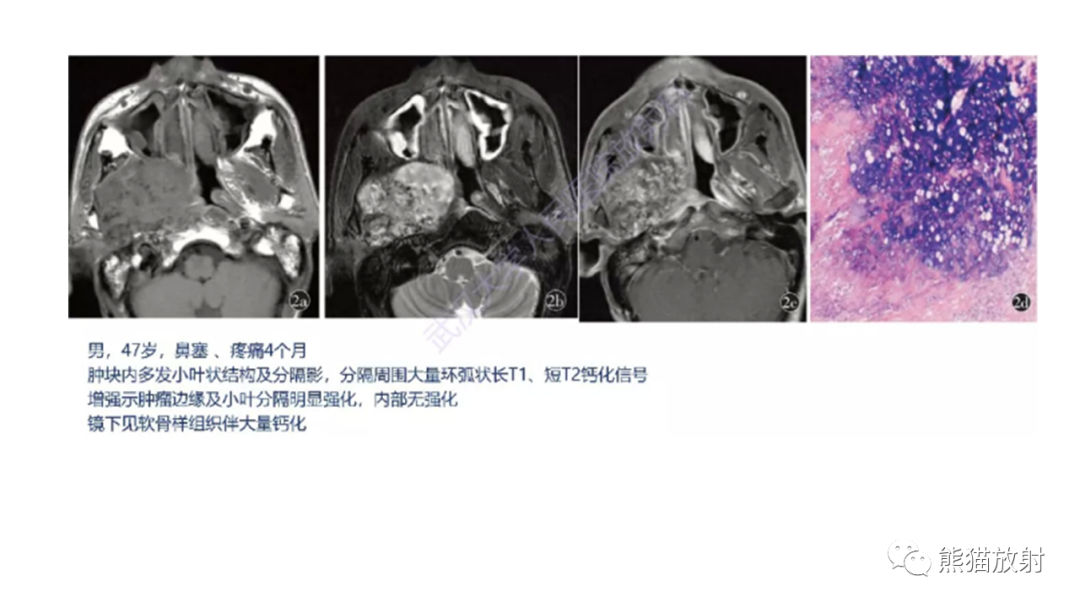 【病例】软骨肉瘤I级 VS 去分化软骨肉瘤-31