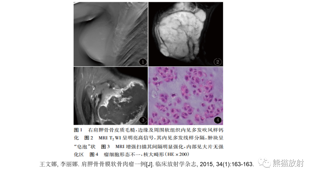 【病例】软骨肉瘤I级 VS 去分化软骨肉瘤-35