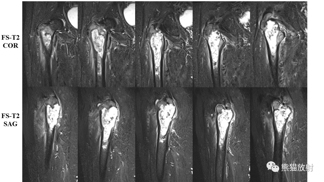 【病例】软骨肉瘤I级 VS 去分化软骨肉瘤-8