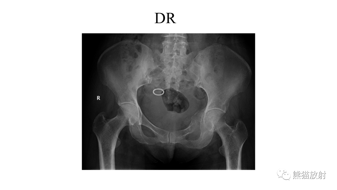 【病例】软骨肉瘤I级 VS 去分化软骨肉瘤-13