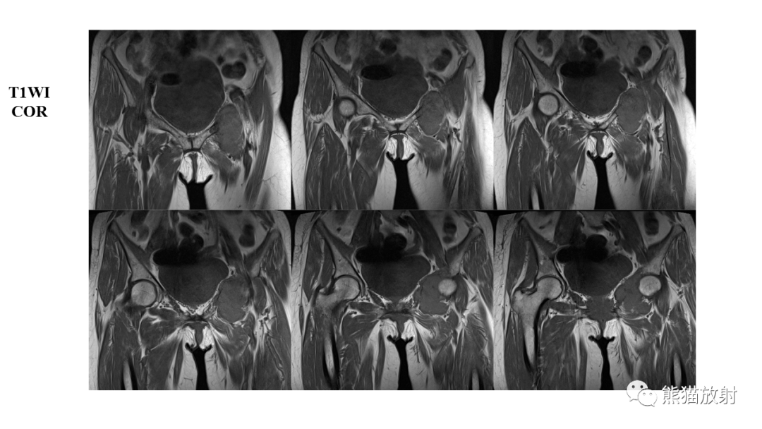 【病例】软骨肉瘤I级 VS 去分化软骨肉瘤-16