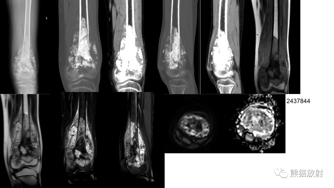 【病例】软骨肉瘤I级 VS 去分化软骨肉瘤-48