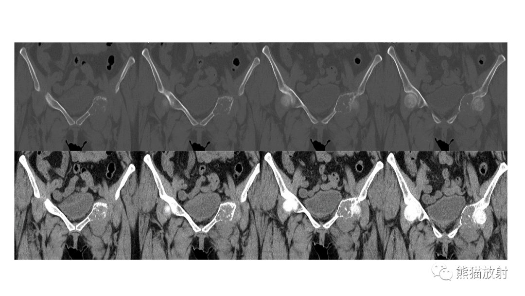 【病例】软骨肉瘤I级 VS 去分化软骨肉瘤-15
