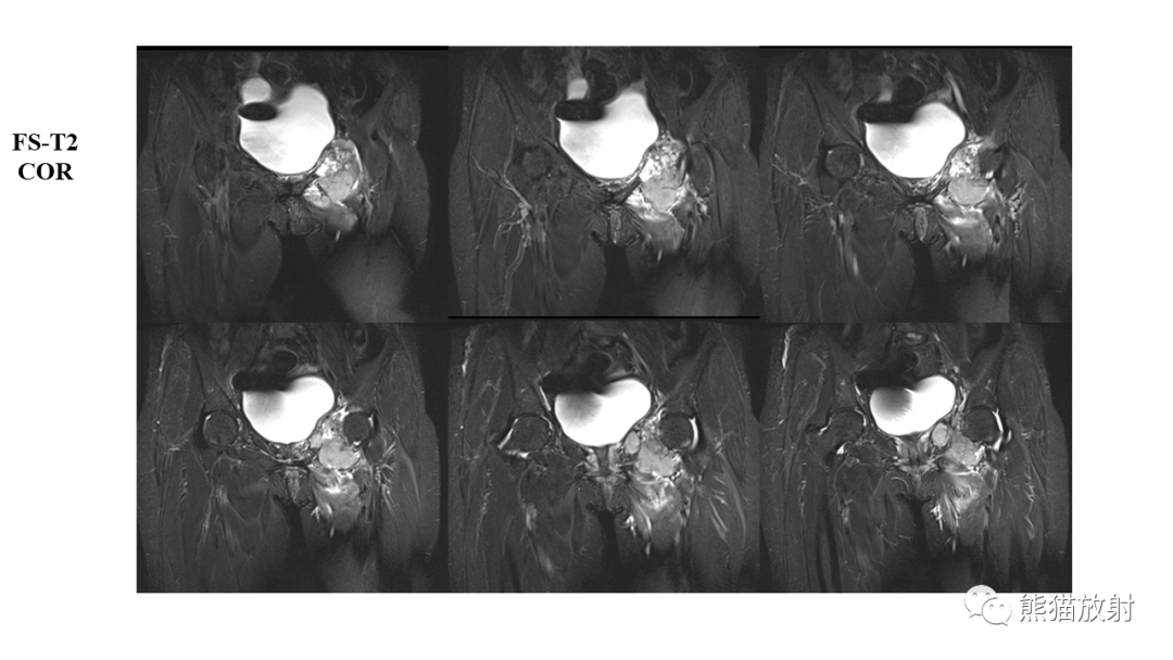 【病例】软骨肉瘤I级 VS 去分化软骨肉瘤-19