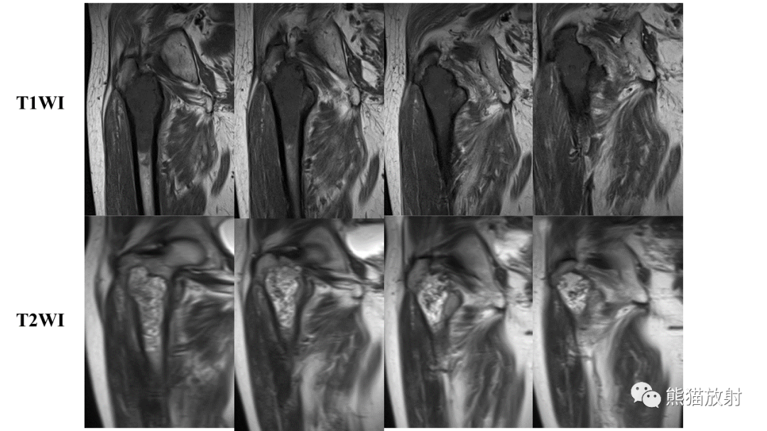 【病例】软骨肉瘤I级 VS 去分化软骨肉瘤-7